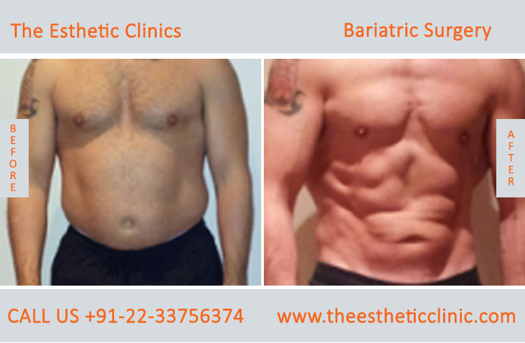 Bariatric Surgery, Weight Loss Surgery before after photos in mumbai india (3)